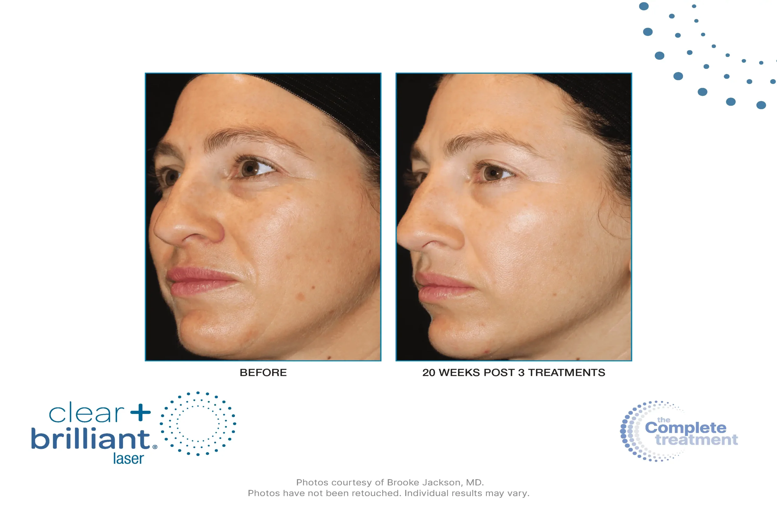 Before and after photos of Skin rejuvenation treatments in New York, NY by Timelyss Medspa