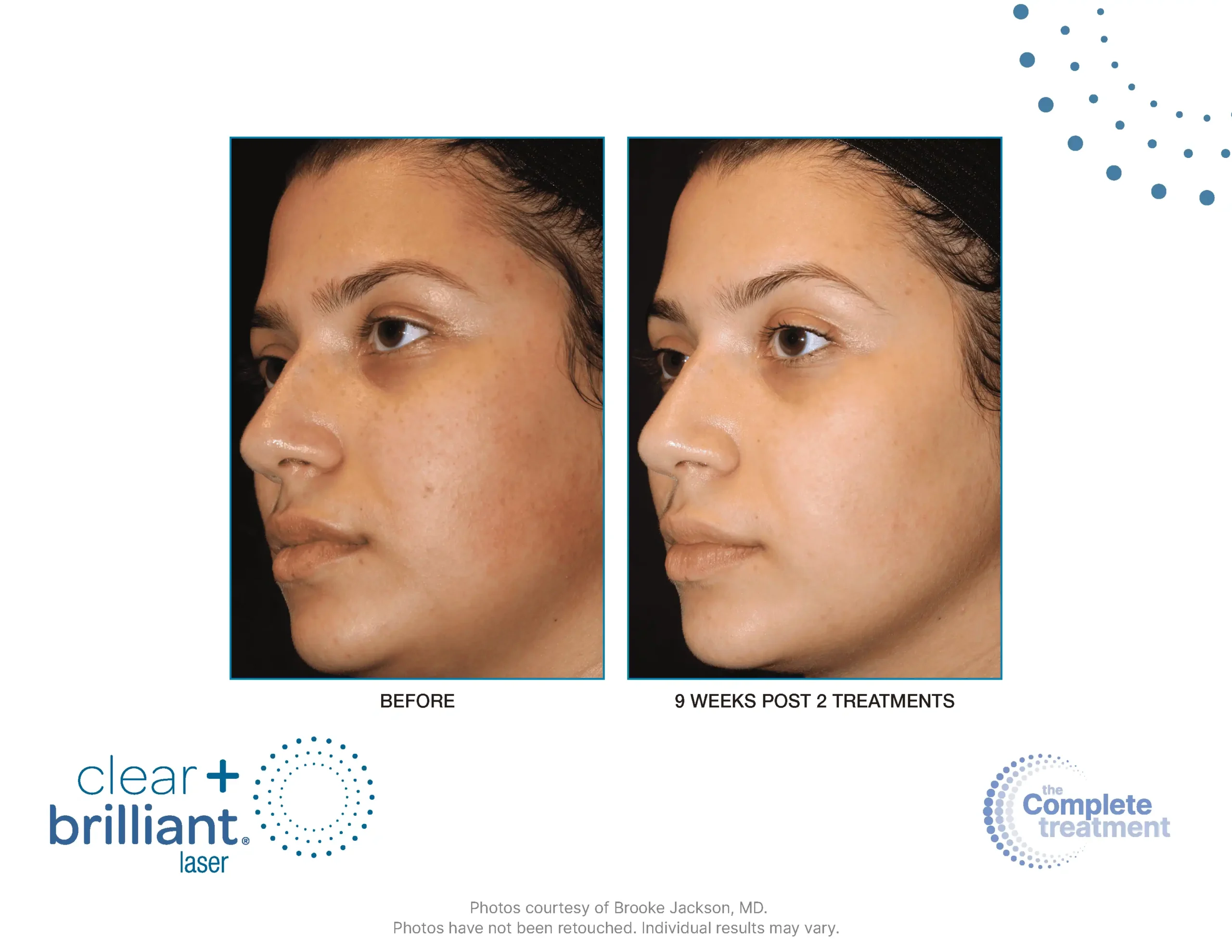 Before and after photos of Skin rejuvenation treatments in New York, NY by Timelyss Medspa
