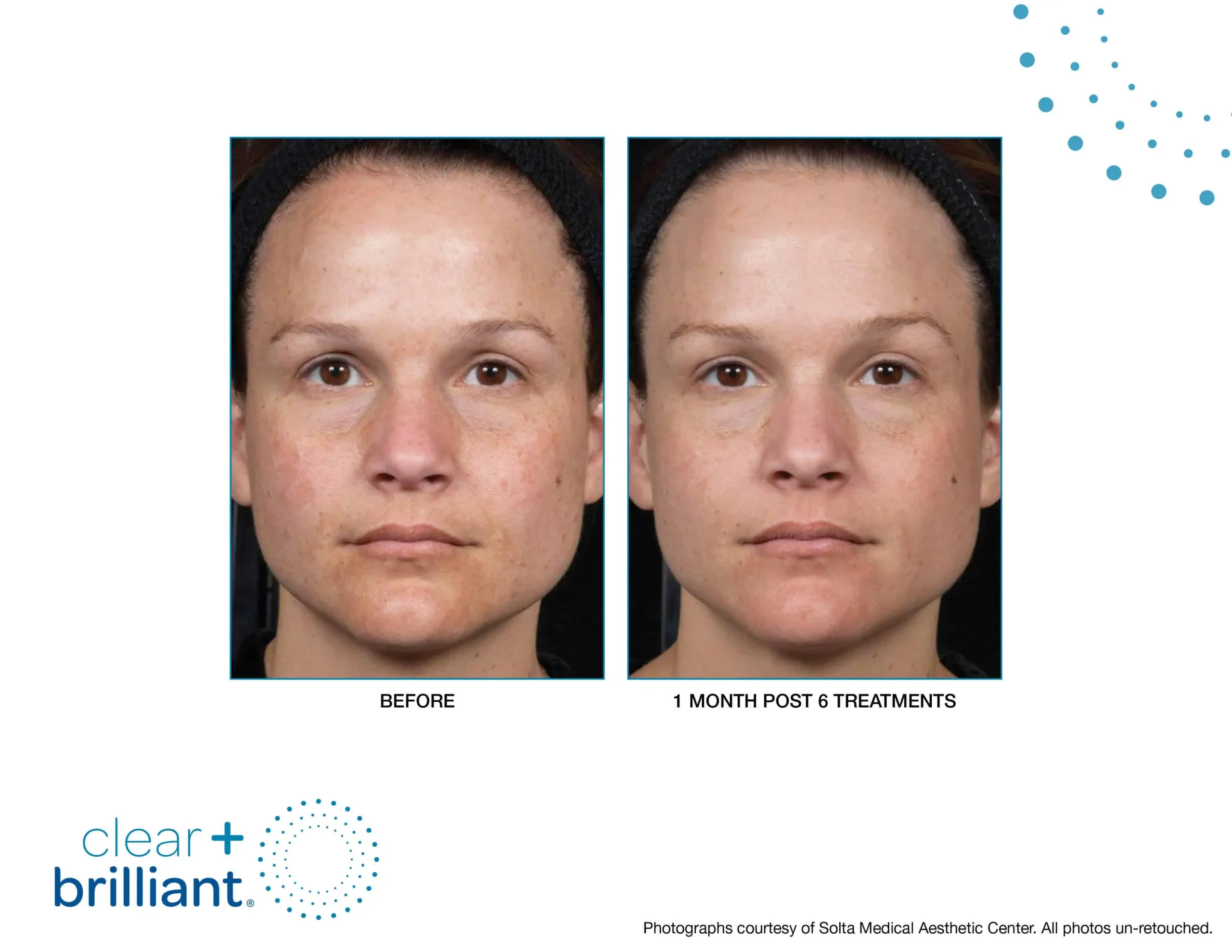 Before and after photos of Skin rejuvenation treatments in New York, NY by Timelyss Medspa