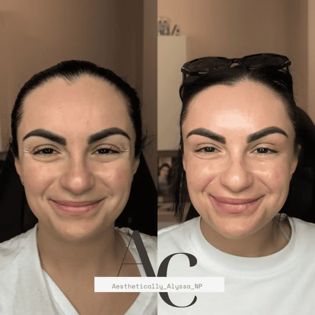Crows-Feet-Neurotoxin-before-after-in-new-york