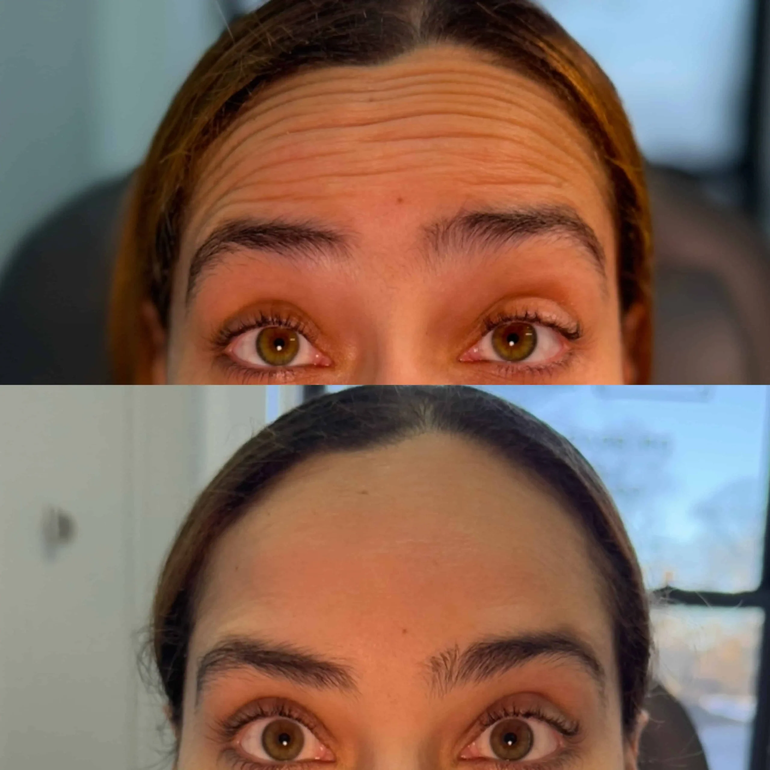 Frontalis-Neurotoxin-Eight-before-after-in-New-York