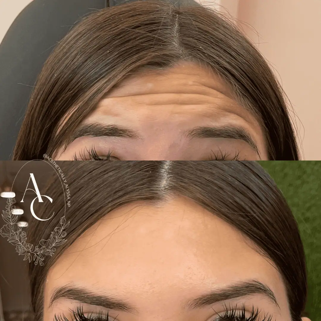 Frontalis-Neurotoxin-Five-before-after-in-New-York