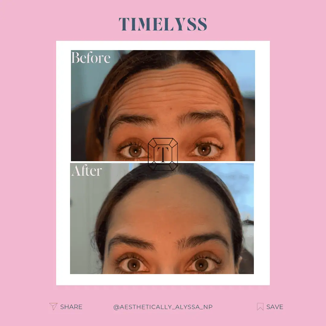 Frontalis-Neurotoxin-Four-before-after-in-New-York