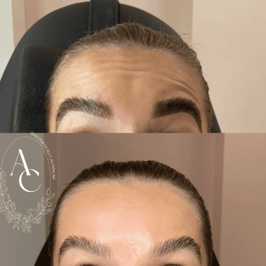 Frontalis-Neurotoxin-One-before-after-in-New-York