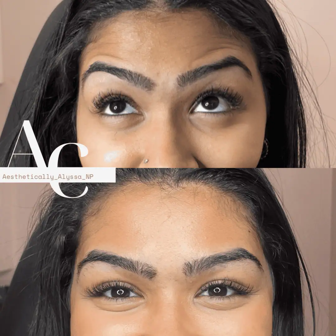 Frontalis-Neurotoxin-Six-before-after-in-New-York