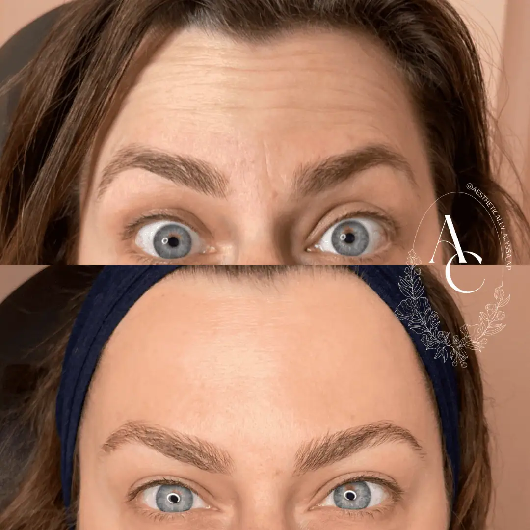 Frontalis-Neurotoxin-Three-before-after-in-New-York