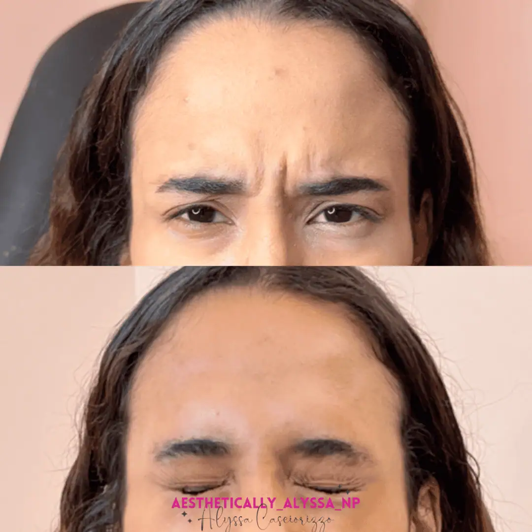 Glabella-Neurotoxin-Five-before-after-in-New-York