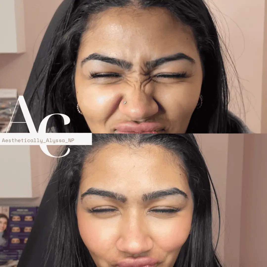 Glabella-Neurotoxin-Four-before-after-in-New-York