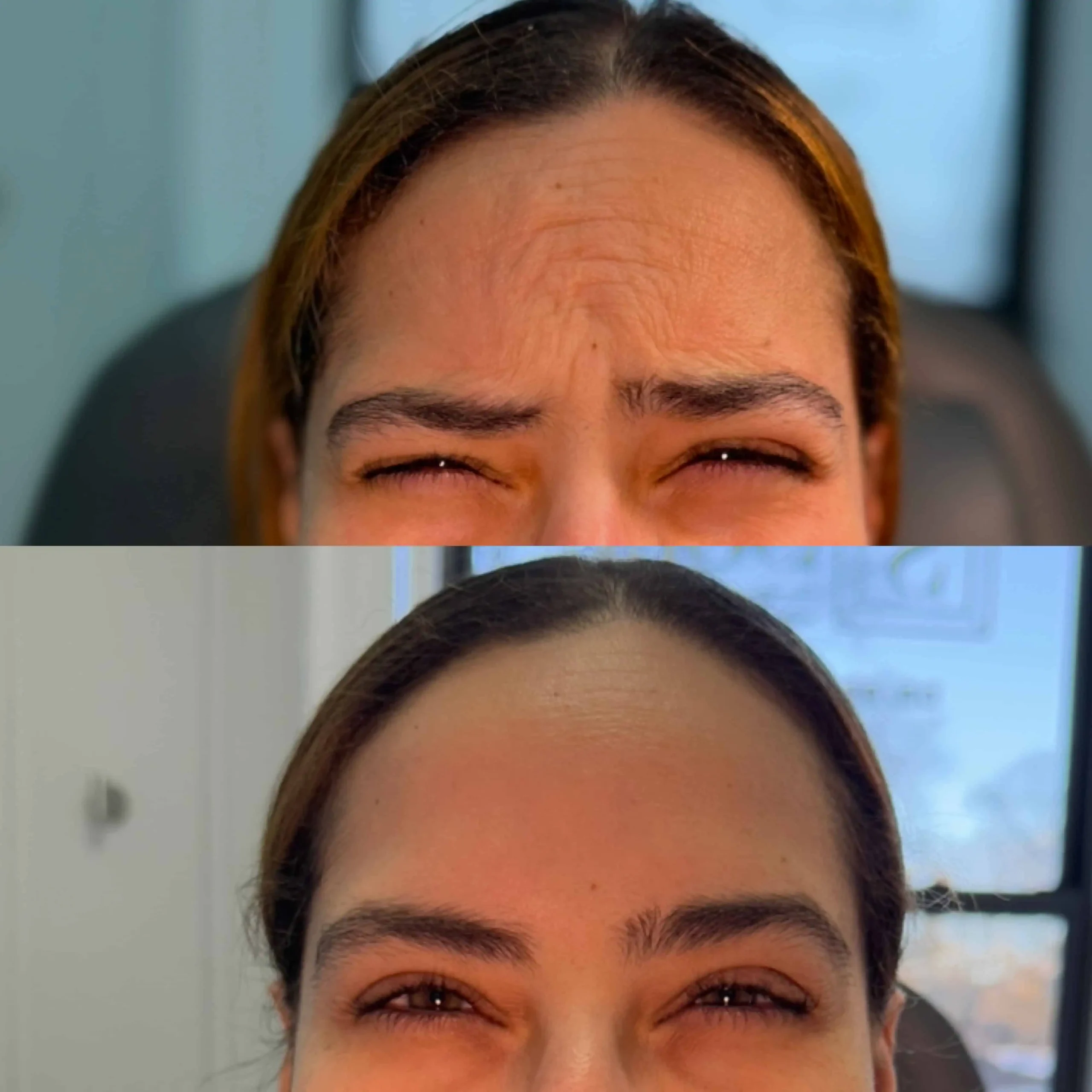 Glabella-Neurotoxin-Nine-before-after-in-New-York