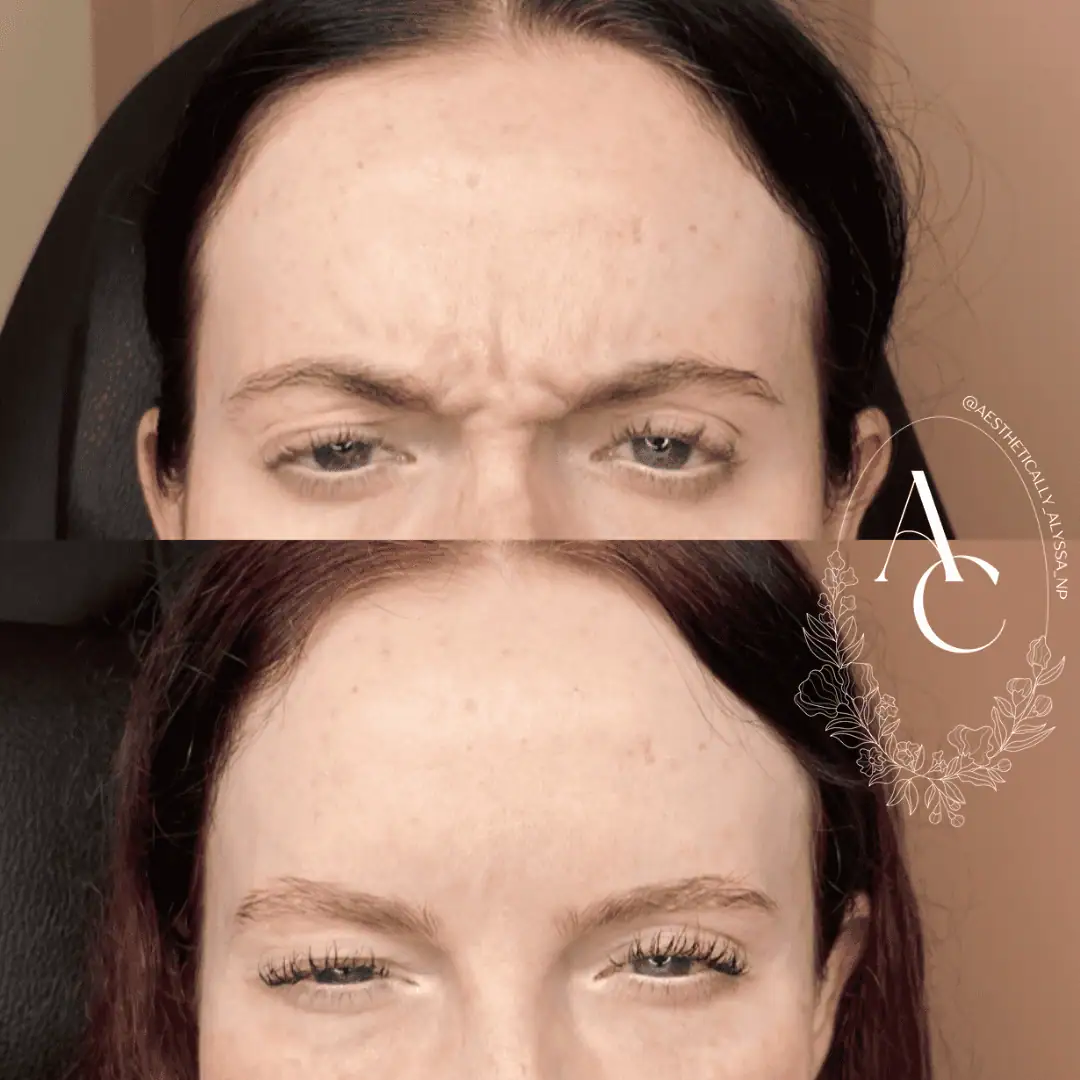 Glabella-Neurotoxin-One-before-after-in-New-York