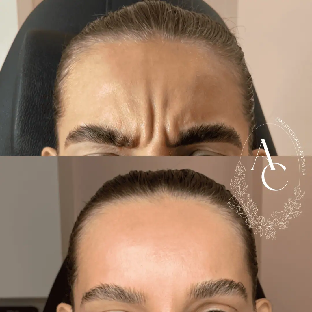 Glabella-Neurotoxin-Seven-before-after-in-New-York
