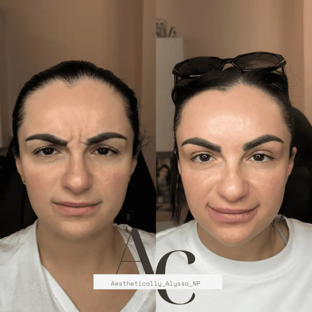 Glabella-Neurotoxin-Ten-before-after-in-New-York