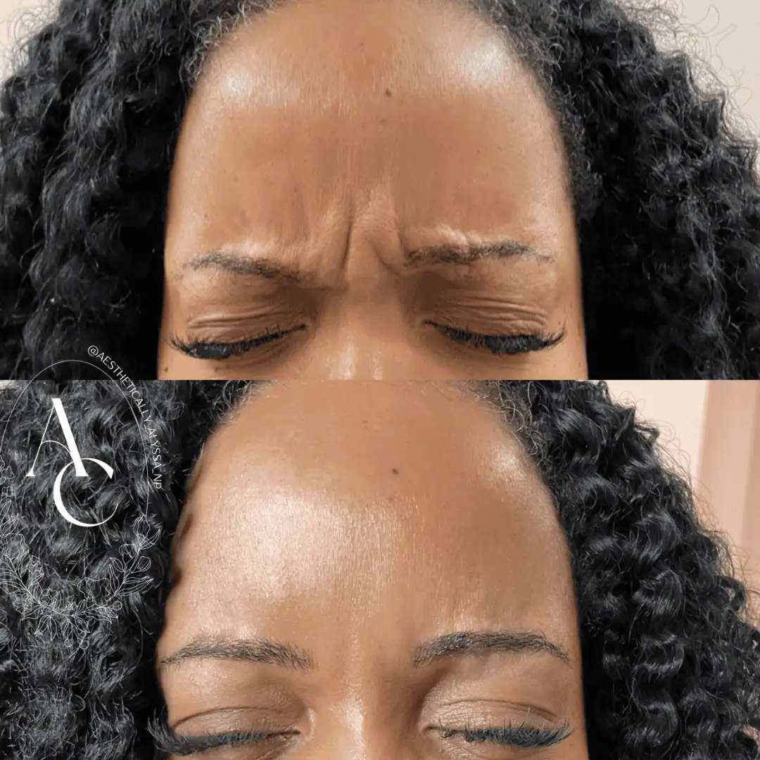 Glabella-Neurotoxin-Three-before-after-in-New-York