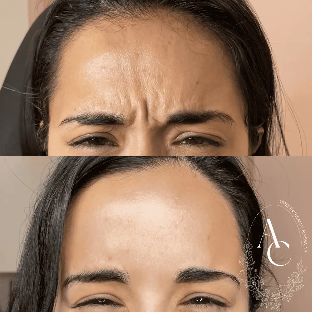 Glabella-Neurotoxin-Two-before-after-in-New-York