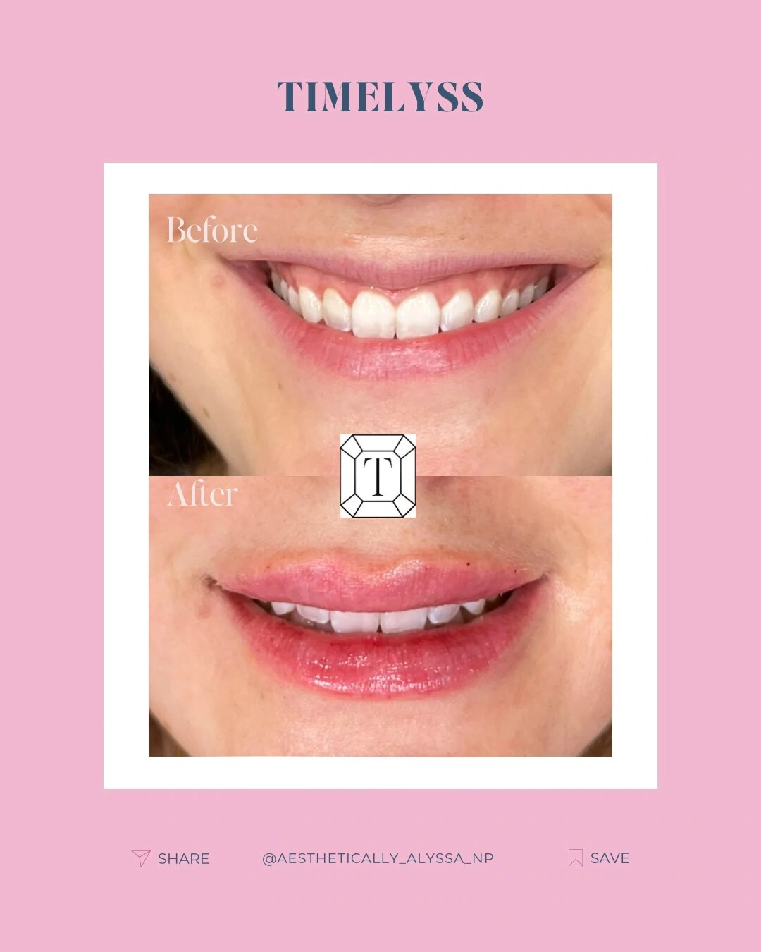 Gummy-Smile-Tox-before-after-in-New-York