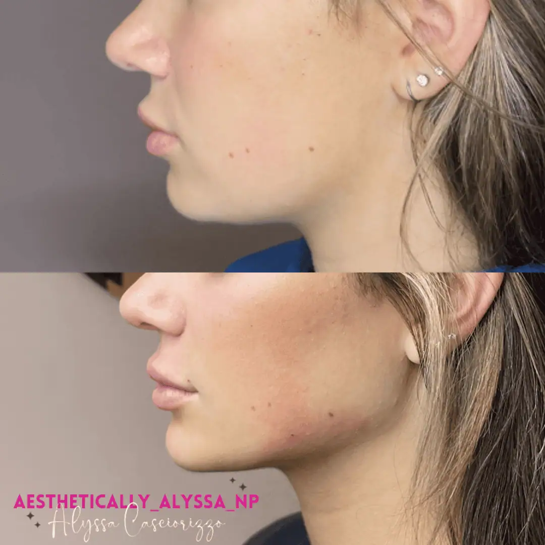 Jawline-Filler-before-after-eight-in-New-York
