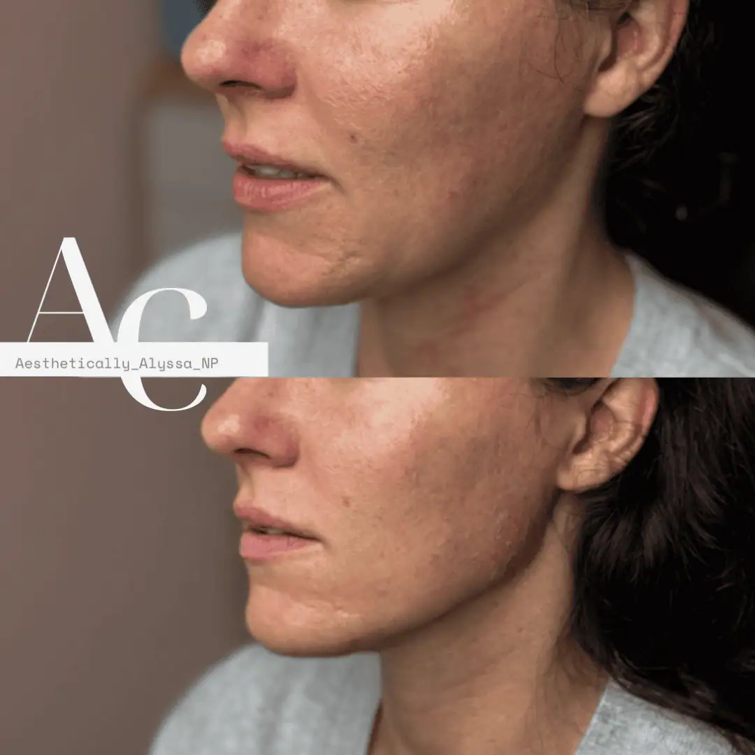 Jawline-Filler-before-after-five-in-New-York