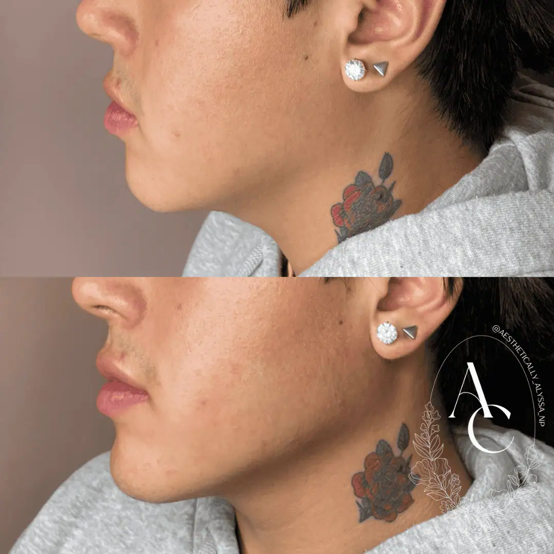 Jawline-Filler-before-after-four-in-New-York