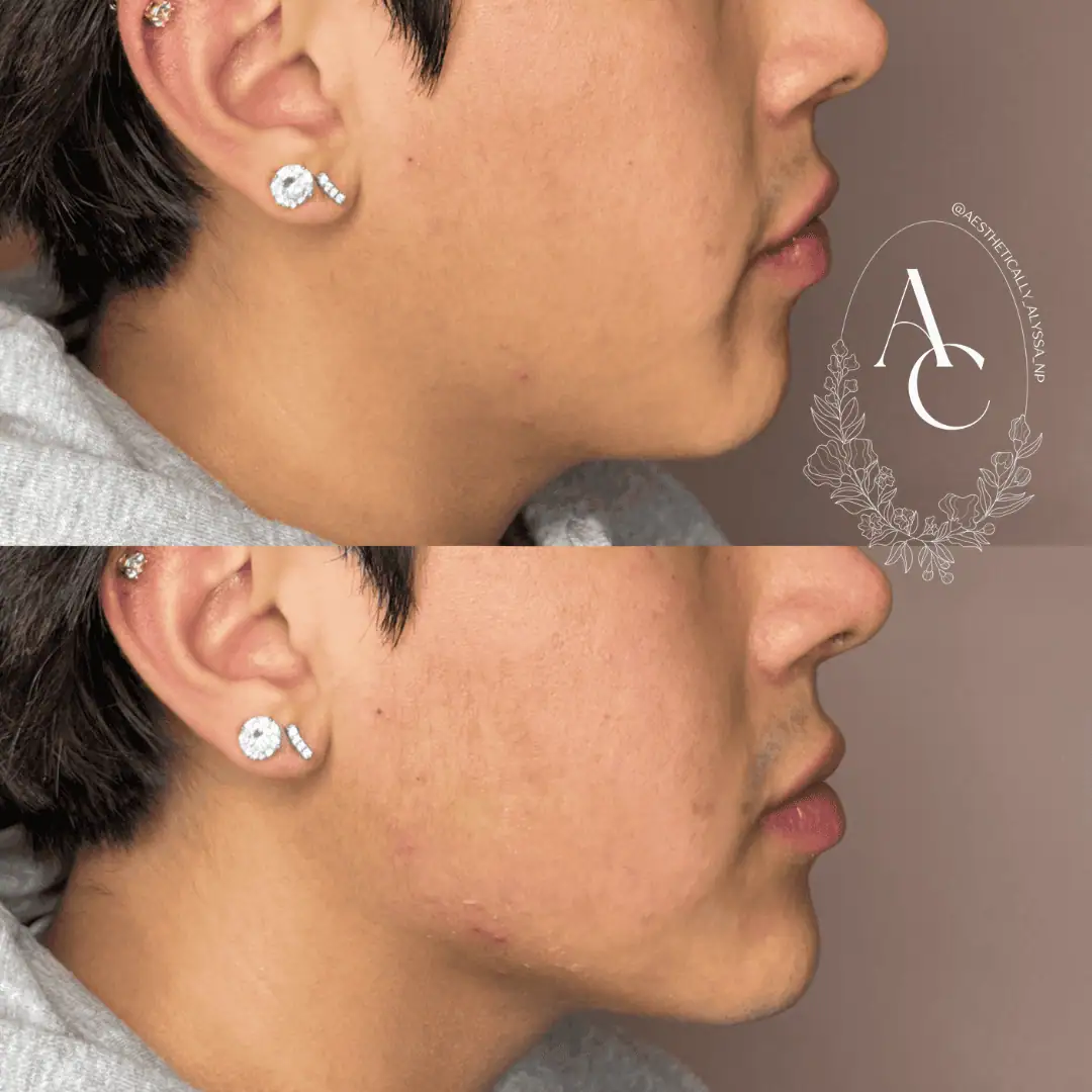 Jawline-Filler-before-after-three-in-New-York