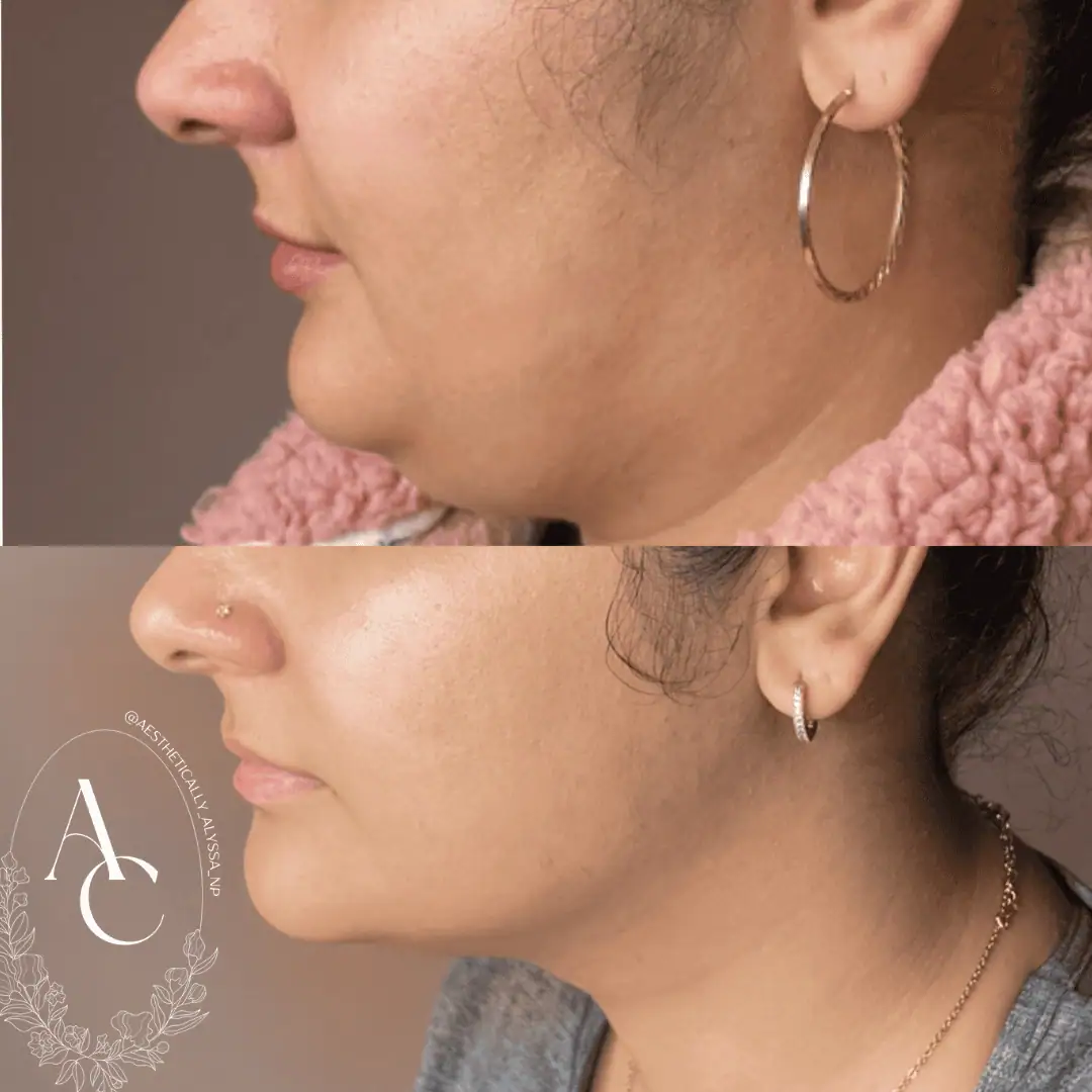 Kybella-before-after-five-in-New-York