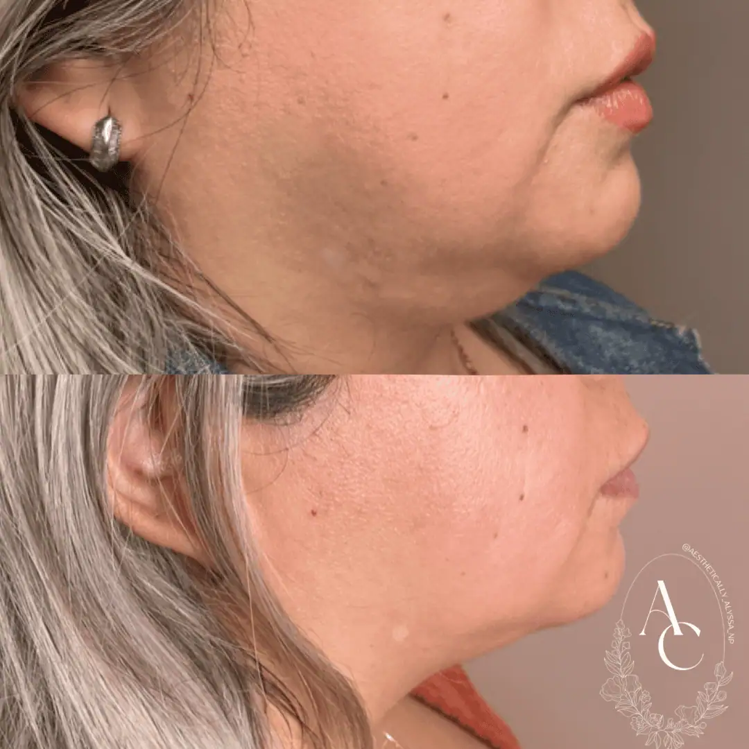 Kybella-before-after-four-in-New-York