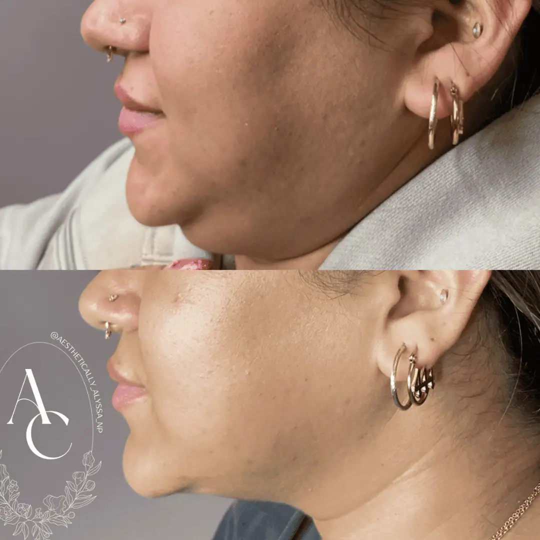 Kybella-before-after-fourteen-in-New-York