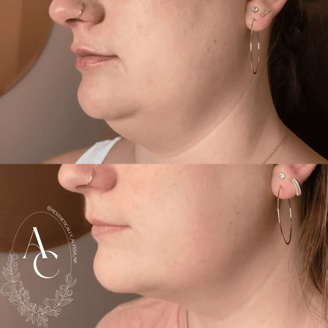 Kybella-before-after-nine-in-New-York