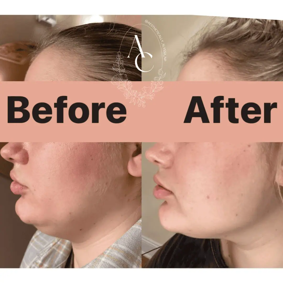 Kybella-before-after-one-in-New-York