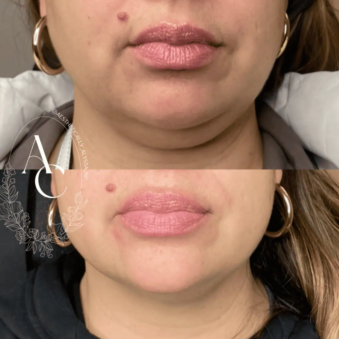 Kybella-before-after-seventeen-in-New-York