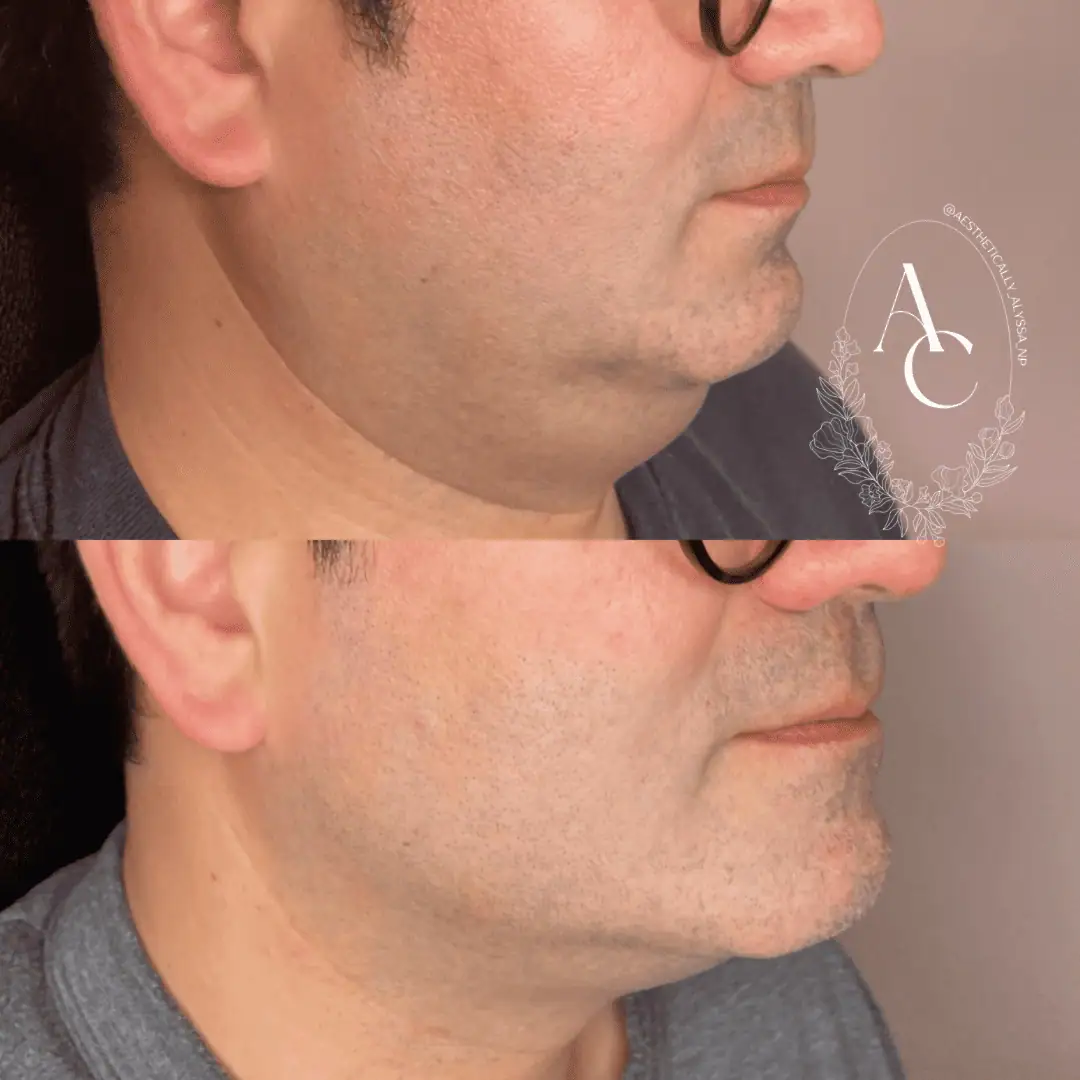 Kybella-before-after-six-in-New-York