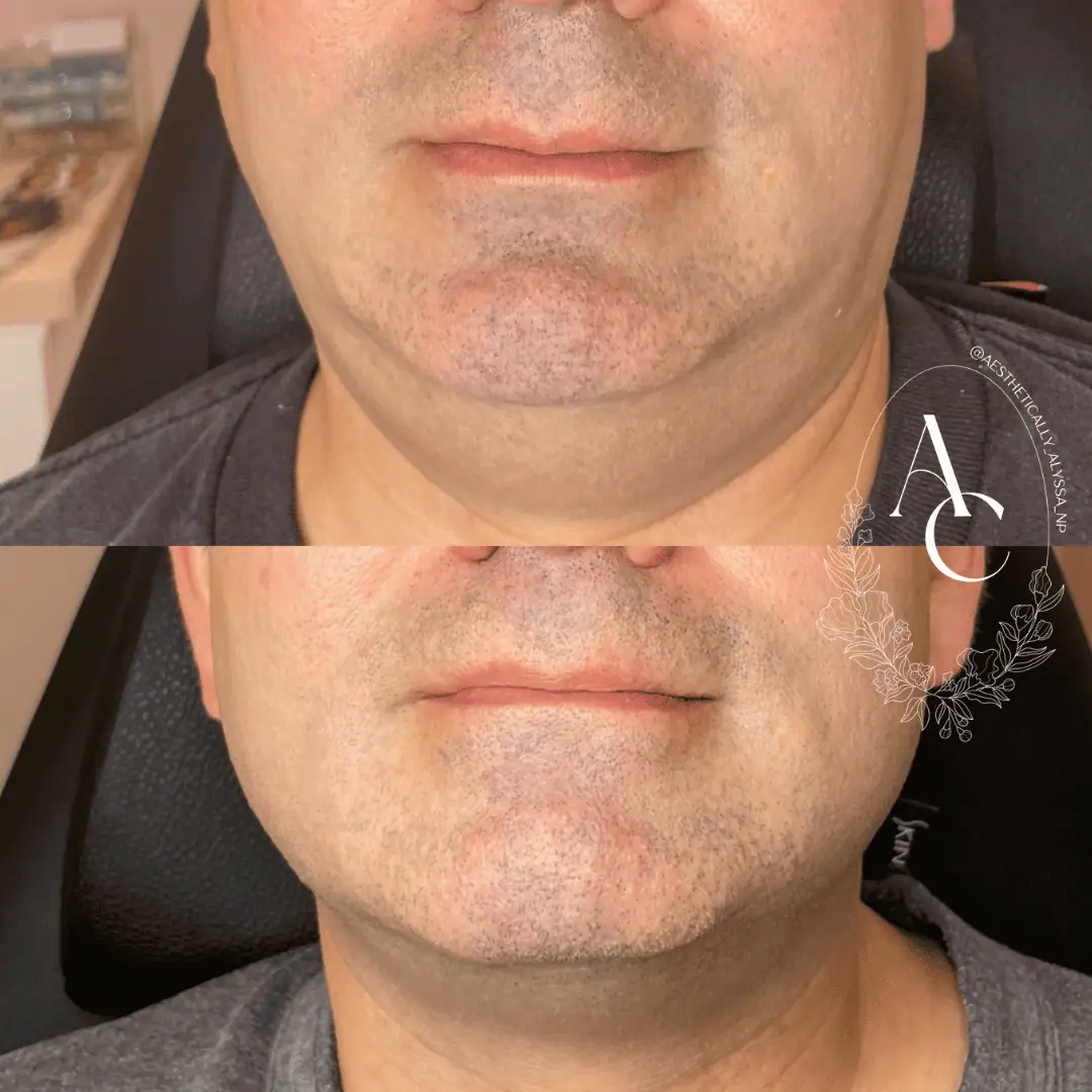 Kybella-before-after-ten-in-New-York