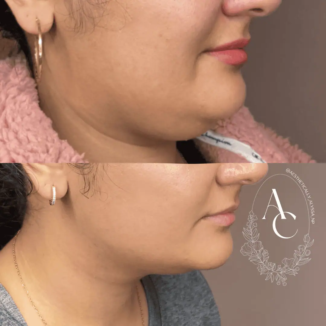 Kybella-before-after-three-in-New-York