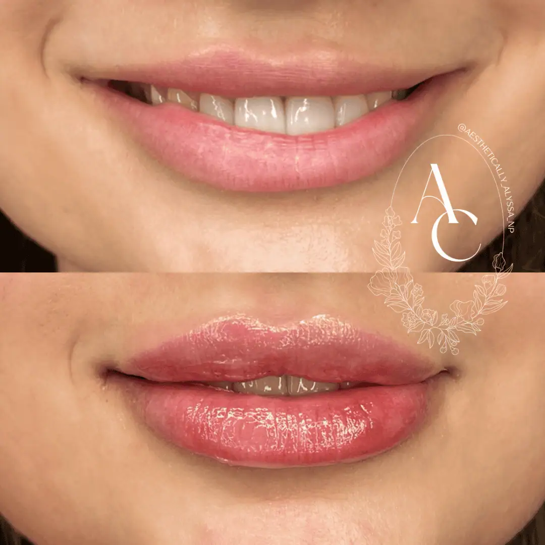 Lip-Filler-before-after-eighteen-in-New-York