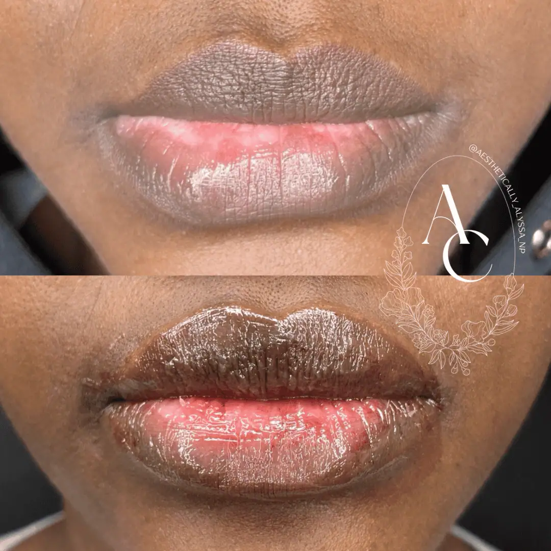 Lip-Filler-before-after-fifteen-in-New-York