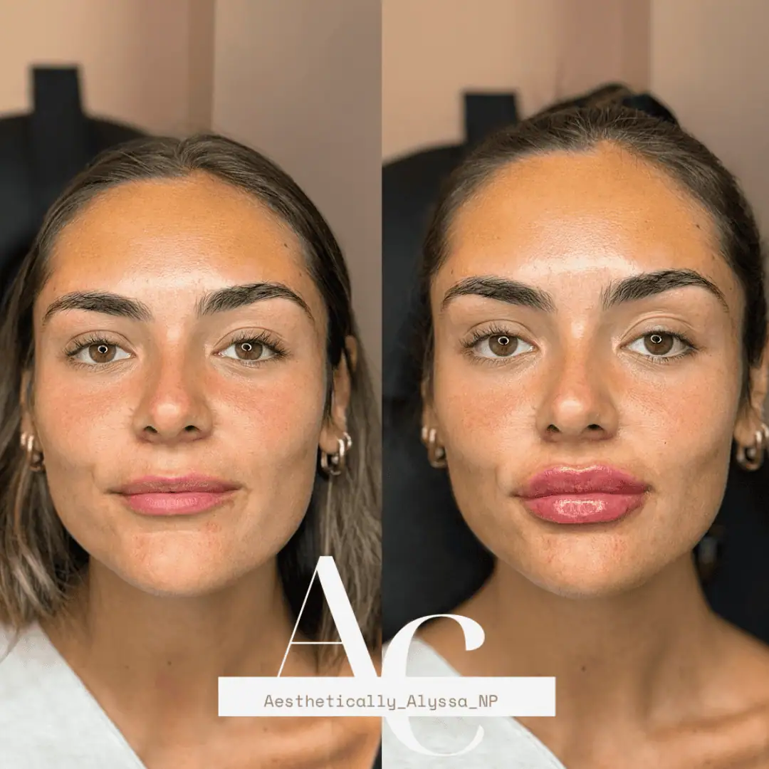 Lip-Filler-before-after-fifty-ones-in-New-York