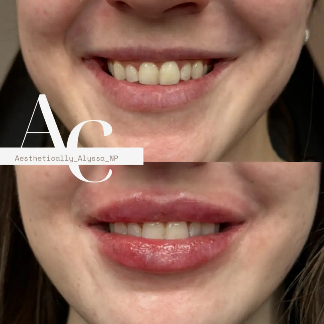 Lip-Filler-before-after-fifty-two-in-New-York