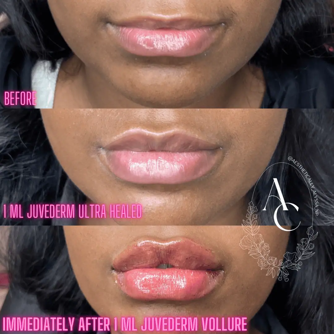 Lip-Filler-before-after-five-in-New-York