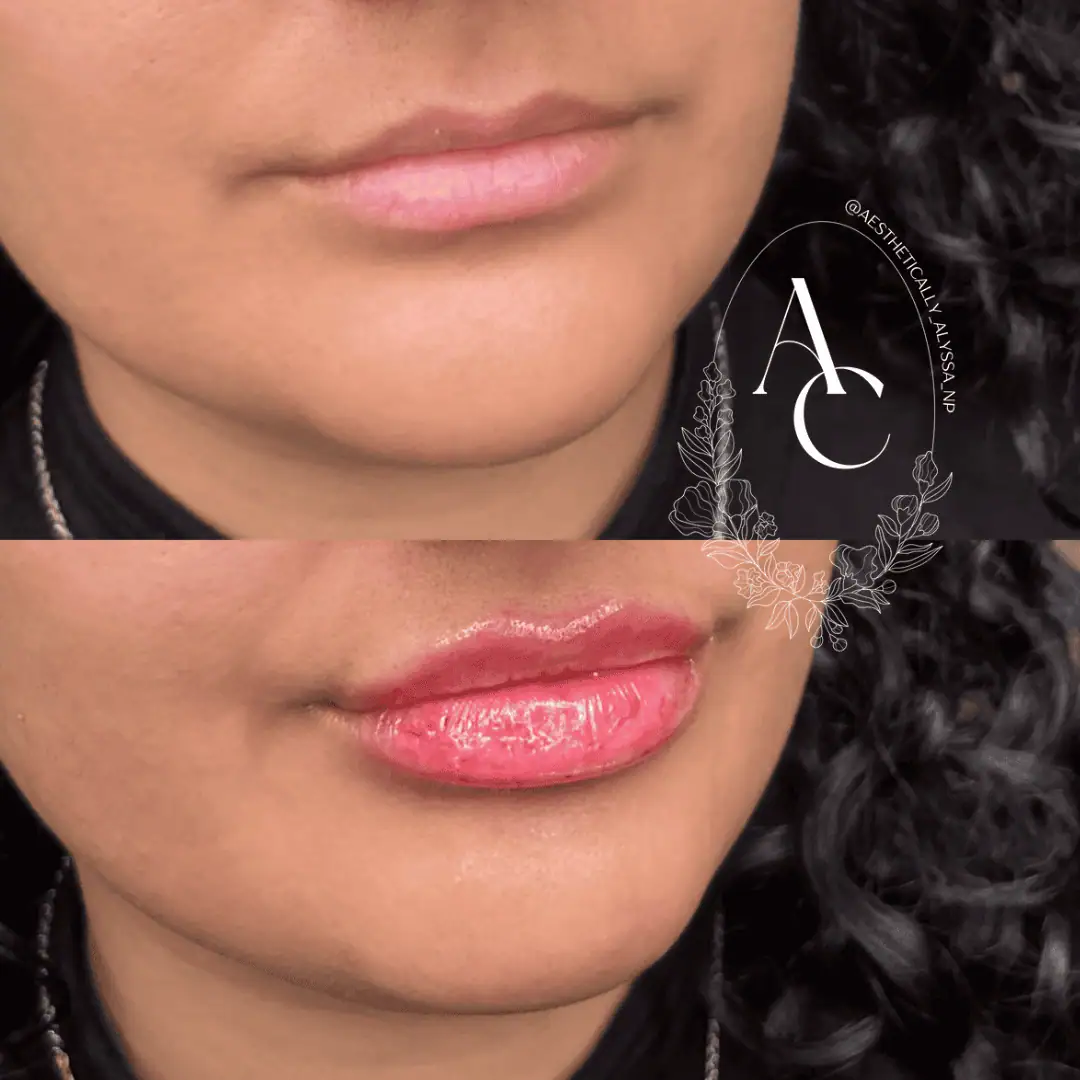 Lip-Filler-before-after-four-in-New-York