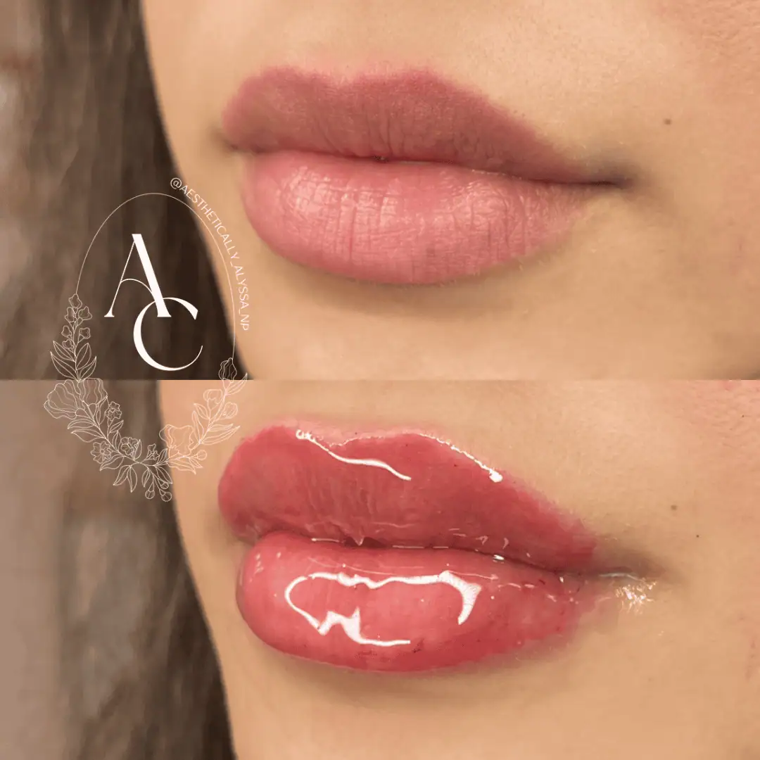 Lip-Filler-before-after-fourteen-in-New-York