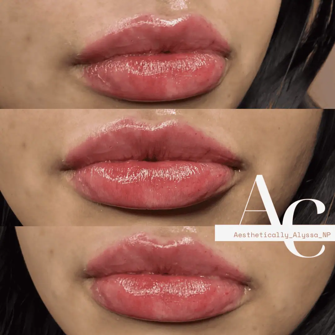 Lip-Filler-before-after-fourtyfour-in-New-York