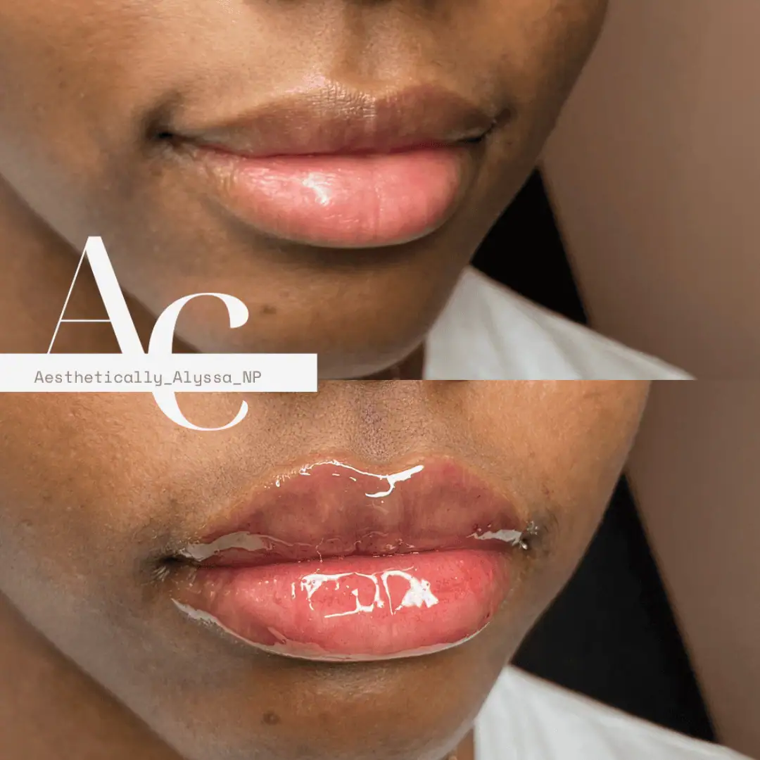 Lip-Filler-before-after-fourtyones-in-New-York