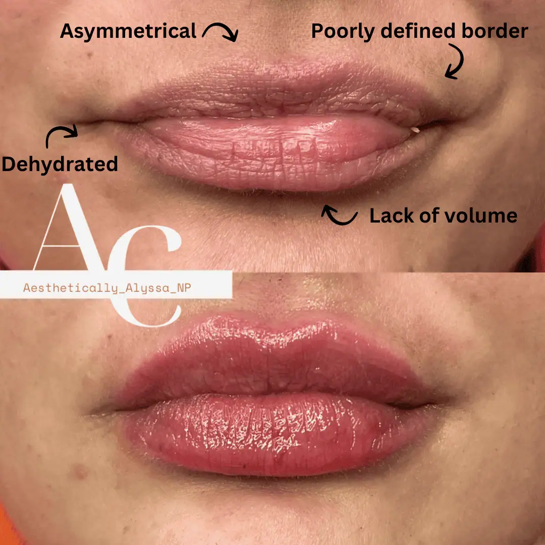 Lip-Filler-before-after-fourtyseven-in-New-York