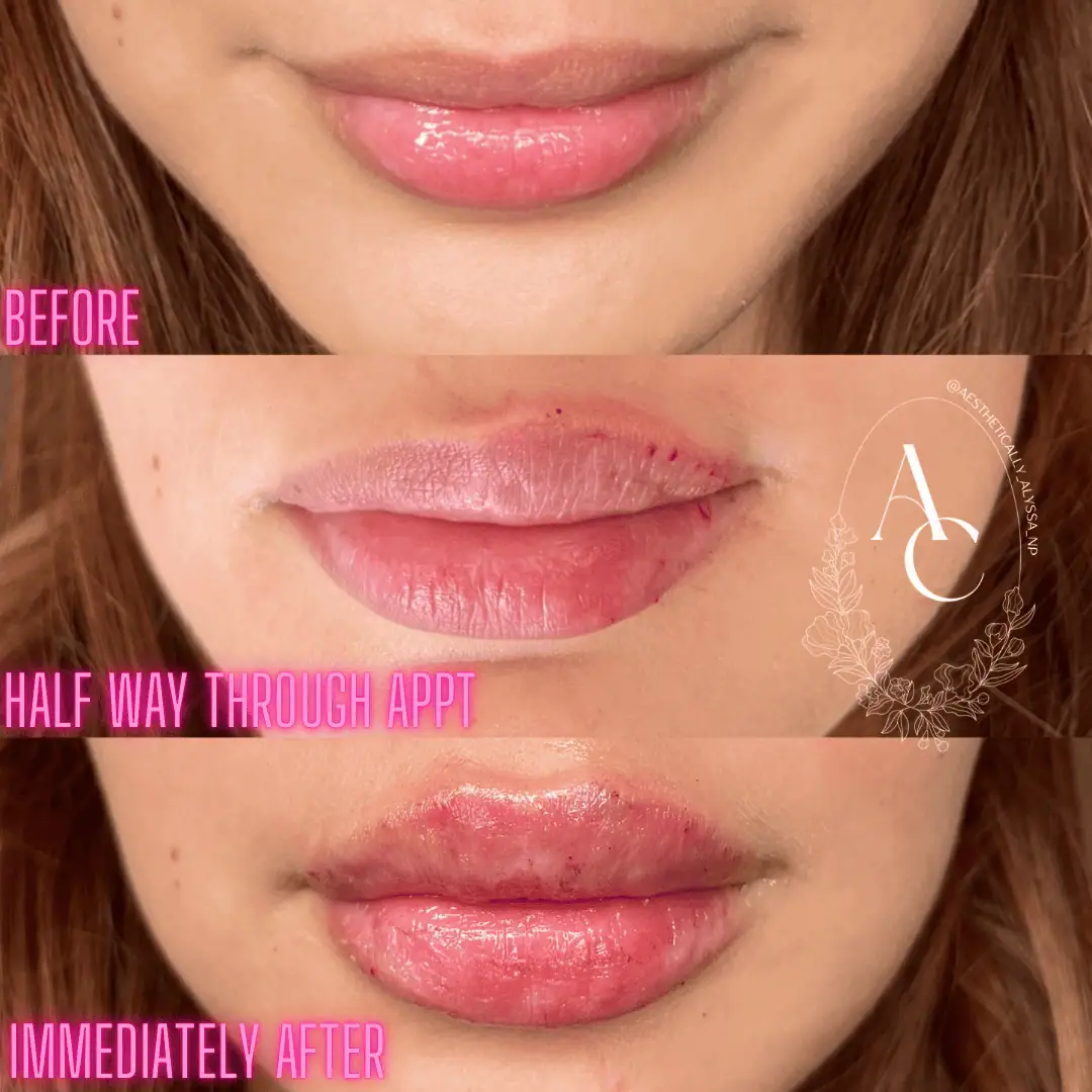 Lip-Filler-before-after-nine-in-New-York