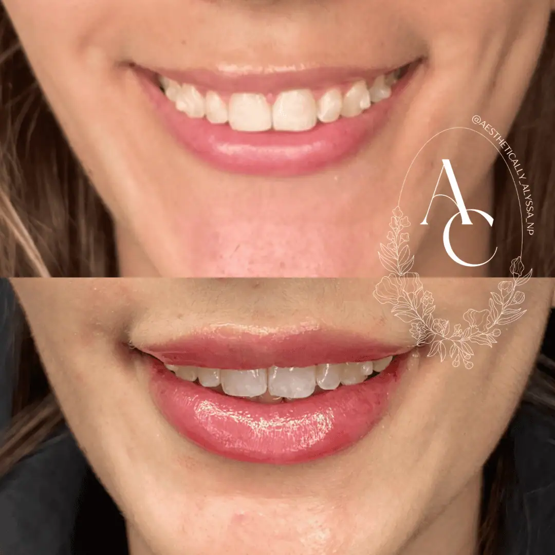 Lip-Filler-before-after-one-in-New-York
