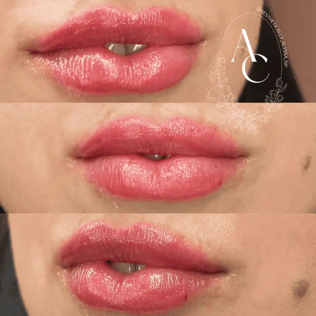 Lip-Filler-before-after-ones-in-New-York
