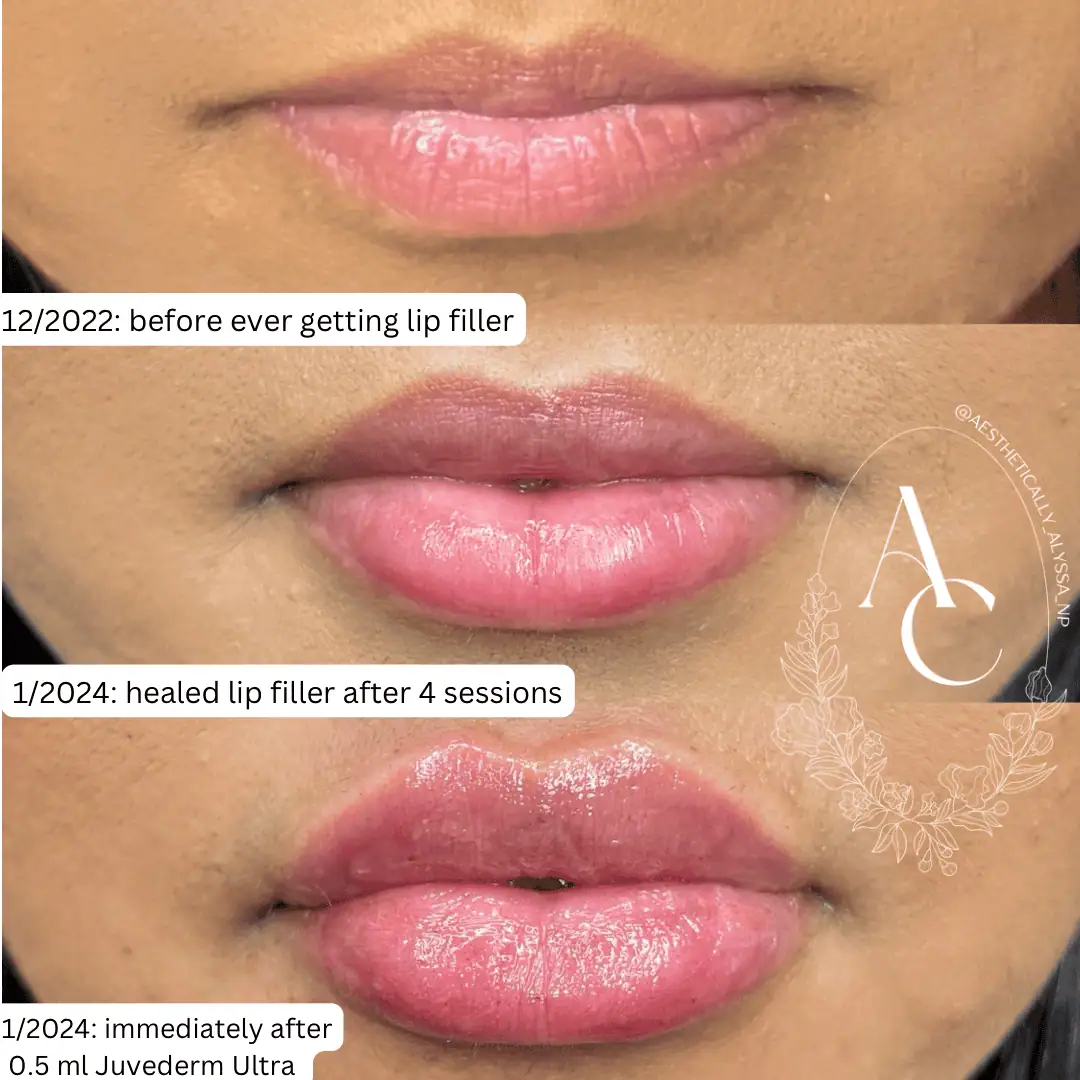 Lip-Filler-before-after-seventeen-in-New-York