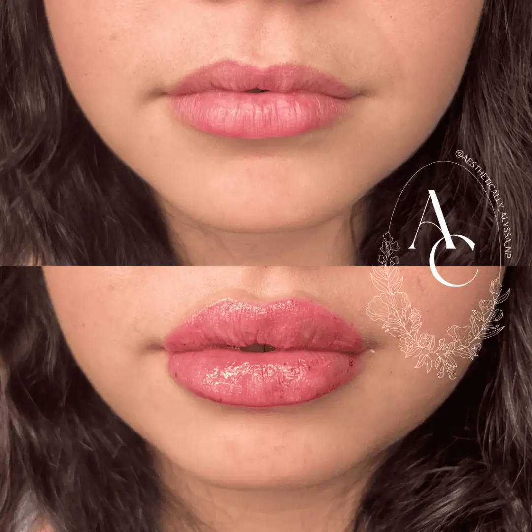 Lip-Filler-before-after-sixteen-in-New-York
