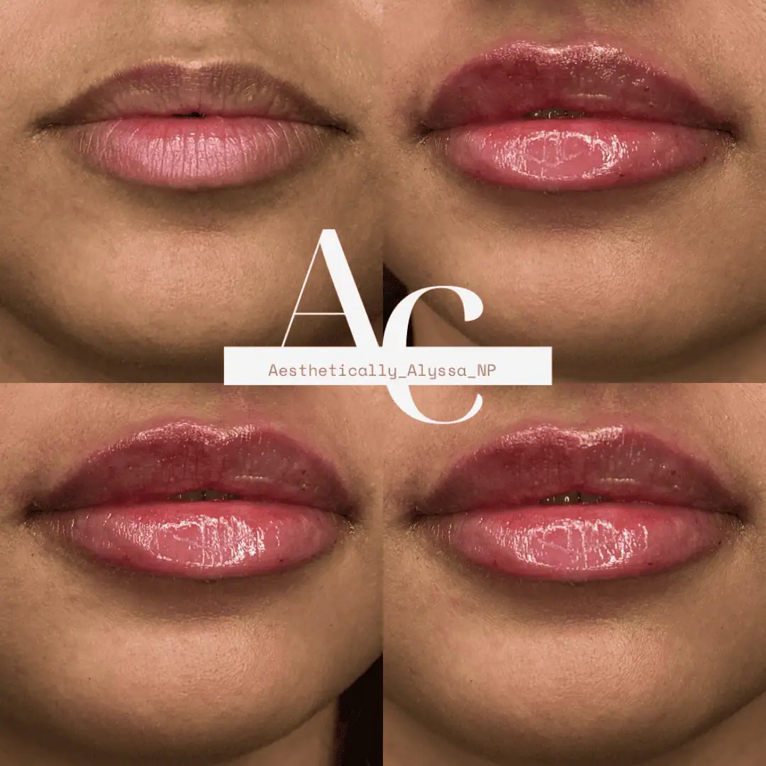 Lip-Filler-before-after-thirty-in-New-York