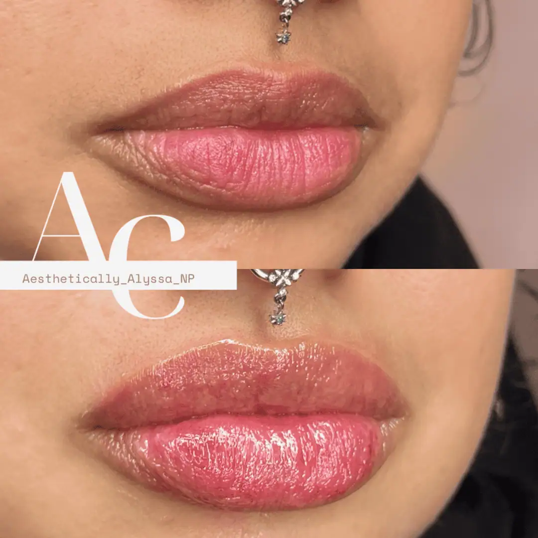 Lip-Filler-before-after-thirtyfive-in-New-York