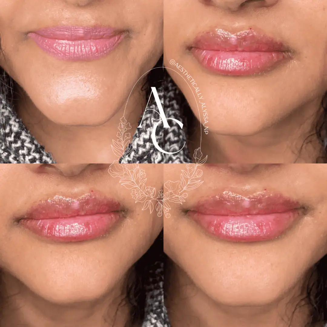 Lip-Filler-before-after-three-in-New-York